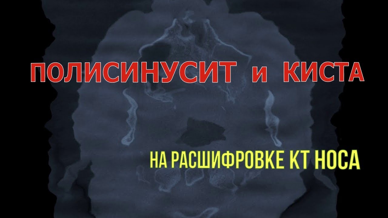 ИСКРИВЛЕНИЕ носовой перегородки с ПОЛИСИНУСИТОМ и в гайморовой пазухе ...