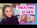 How To Treat Scars: Flat, Depressed, Raised, and Keloids | Dr. Shereene Idriss