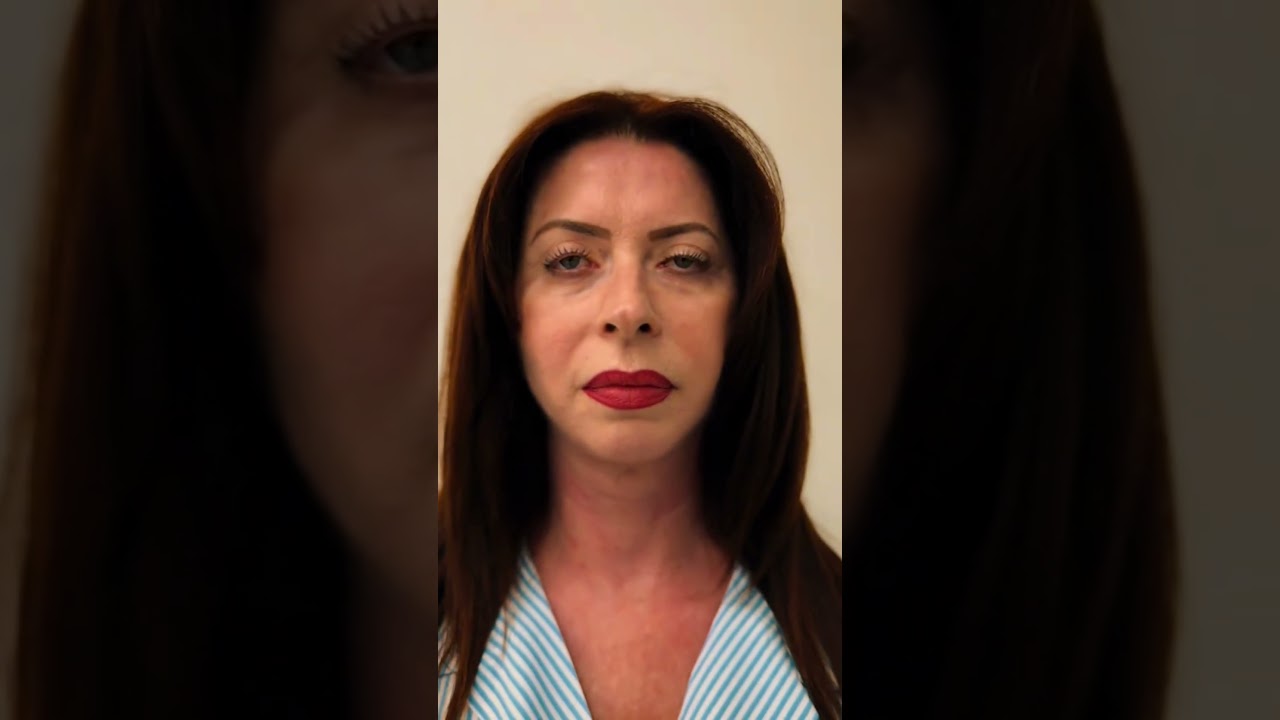 WOW rezultat înainte și după BLEFAROPLASTIE la Clinica Dr. Levy Medical Center