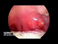 Quinsy  peritonsillar abscess  dr sunil kewat