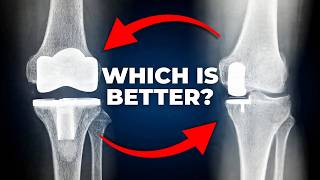 Partial vs Total Knee Replacement: Which One Fits Your Knee
