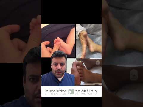 دكتور طارق الفهد و اهتزاز قدم الطفل دليل على