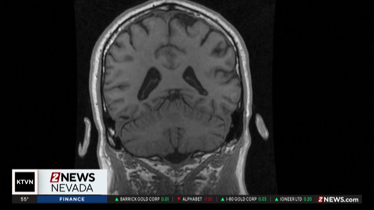 Health Watch: Autoimmune encephalitis