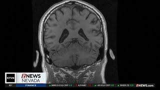 Health Watch: Autoimmune encephalitis