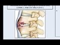 Spinal Tuberculosis