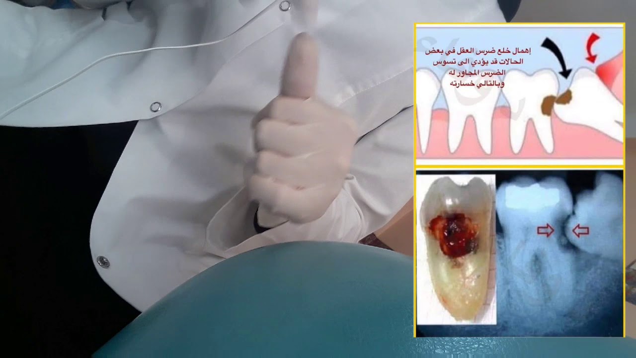 ضرس العقل و مشاكله .لماذا سمي بهذا الاسم ؟ أشكال ظهوره .متى نحتفظ به ...