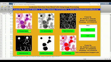 Leukemia Blood Cancer Detection from Blood Cells Using Matlab Source Code | Leukemia Classification