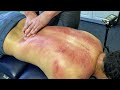 TOXIC Scraping looks like Road Rash...Must SEE! Fixing a Fighters Neck and Back Part 2