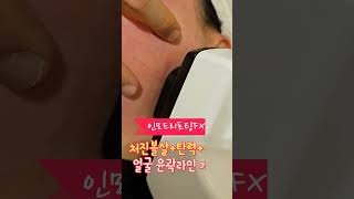 이중턱 시술 인모드 FX 레이저 턱라인 리프팅 🔥