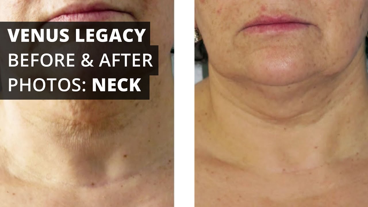 Venus Legacy™ Before & After Photos Neck YouTube