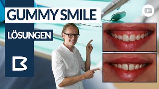 GUMMY SMILE - Zahnfleischlächeln korrigieren? ALLES dazu in diesem Video!