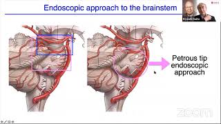 Endoscopic Subtemporal or Petrous Tip Approach for Brainstem Lesions- Kiyoshi Saito