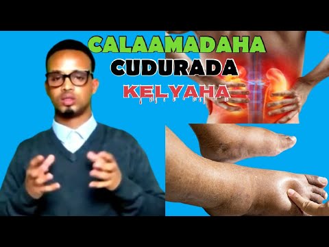 Calaamadaha Cudurada Kelyaha | 10 Calaamadood