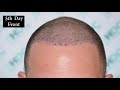 How should I look a few days after my FUE Hair Transplant Surgery?