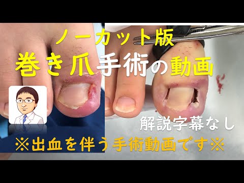 巻き爪の手術動画(ノーカット)です。解説字幕なし：医療関係者向け参考動画 　Ingrown Toenails:Phenol cauterization method★uncut video