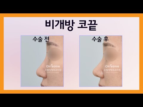 코끝만 올리고 싶더라구 (비개방 코성형 | 비개방 코끝)