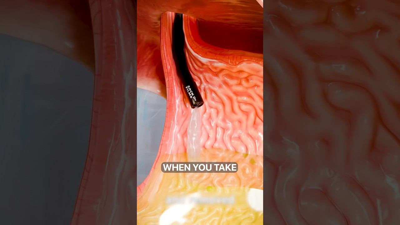 How A Gastric Balloon Works 🤔 Surgeon Reacts