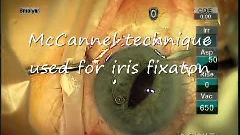 Iris Sutured IOL . Complicated cataract surgery. Операция катаракты.