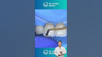 Khắc phục răng cửa xấu |Dr Cường Offical