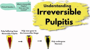 Irreversible Pulpitis | Causes, Diagnosis and Treatment |  Endodontics