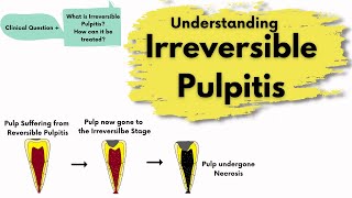 Irreversible Pulpitis | Causes, Diagnosis and Treatment |  Endodontics