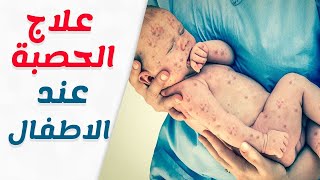 علاج الحصبه