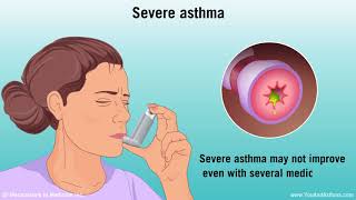 Understanding Asthma: Mild, Moderate, and Severe