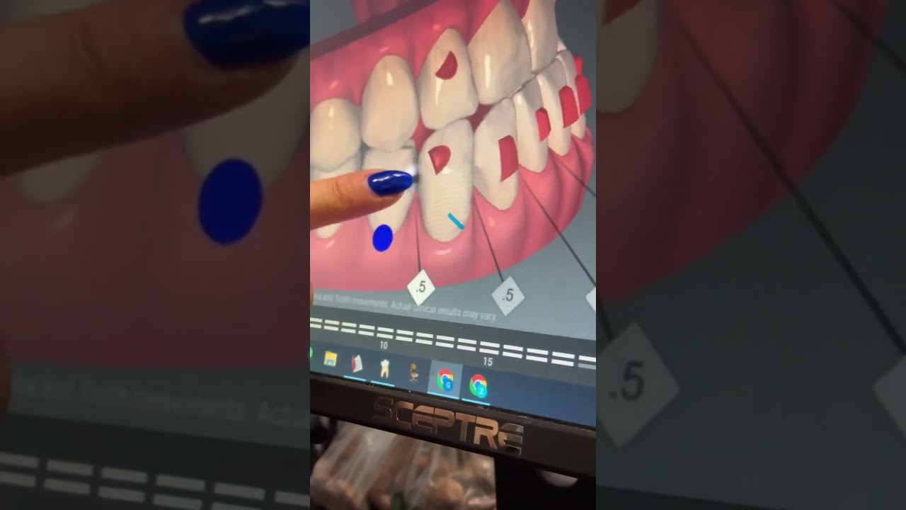 Why We Gently Shave 0.5mm Between Teeth During Invisalign | Carmel Valley Dentist