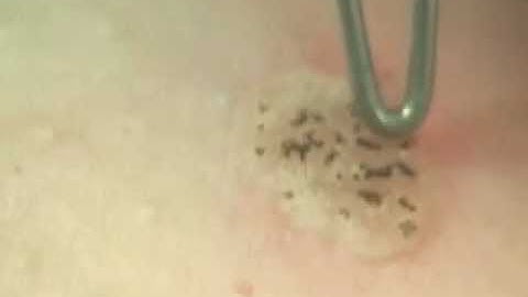 Dual Yellow seborrhoeic keratosis treatment