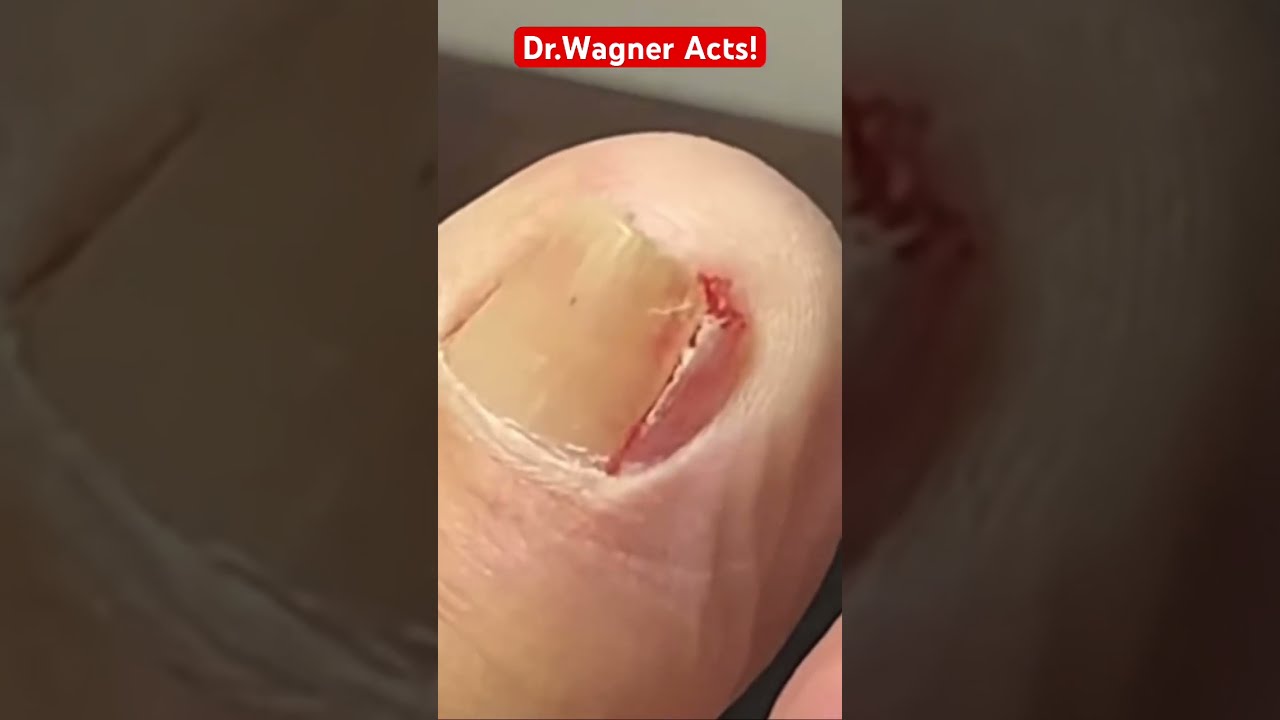 REMOVAL OF A MAMMOTH INGROWN TOENAIL Shorts