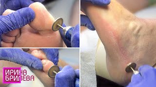 Pedicure 🌸 Treatment of feet and toes with discs 🌸 Irina Brilyova