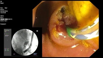 ERCP ; Peridiverticular type ampulla with CBD stones removal.