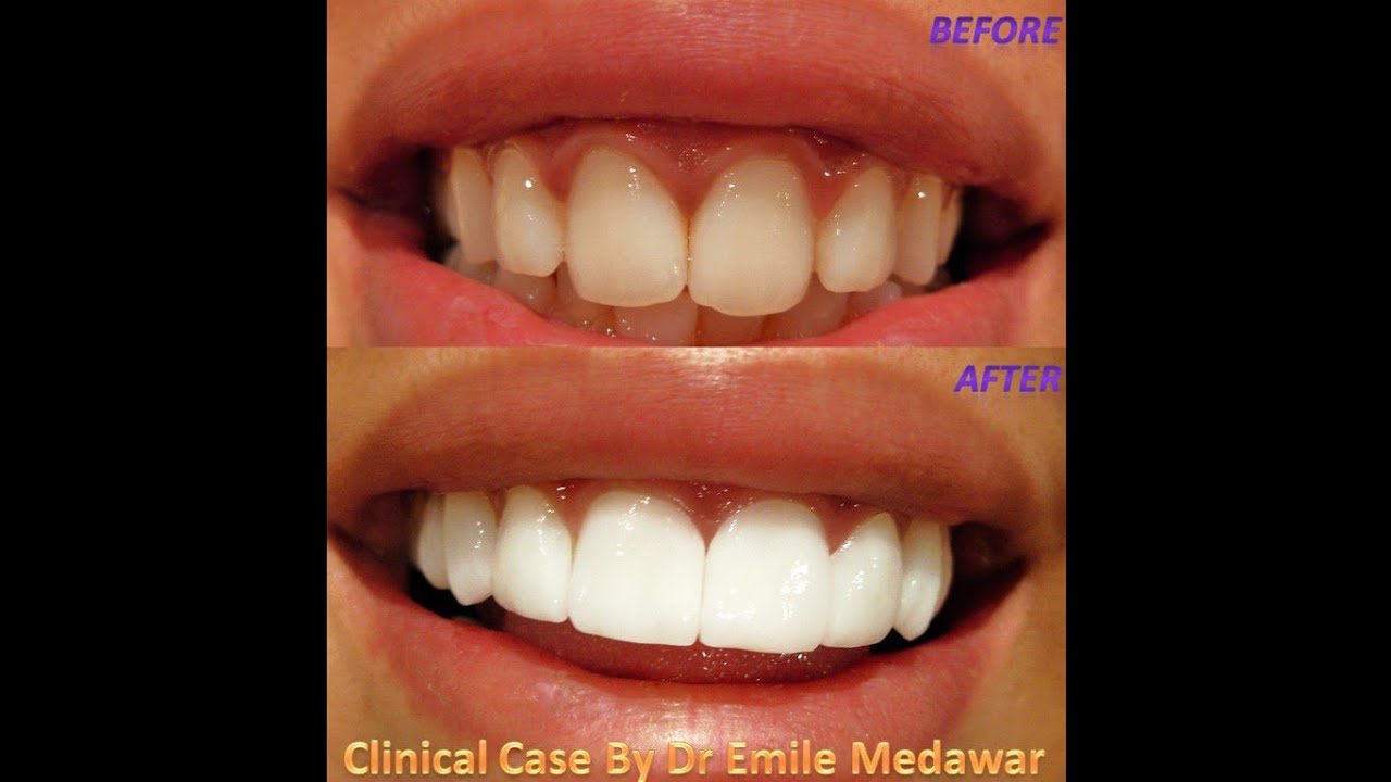 Beirut Lebanon Emax veneers dentistry Hollywood smile at style dental