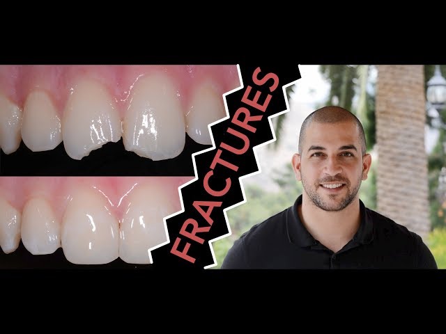 Repair Broken Teeth - Dr Jamilian
