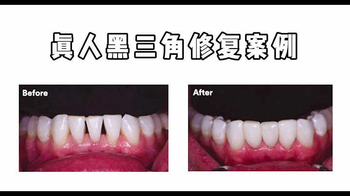 牙齿矫正必看：牙齿出现“黑三角”？别急着崩溃，看看怎么补救！ - 天天要闻