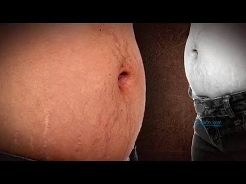 რა შემთხვევებში უჩნდება სხეულს სტრიები - კანქვეშა ქსოვილის ნახეთქები?