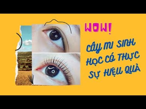 mi cn  Update New  Cấy mi sinh học là gì? Có hiệu quả không?