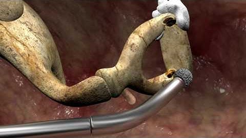 Stapedotomy surgery for Otosclerosis