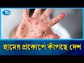 দেশের বিভিন্ন জেলায় ছড়িয়ে পড়েছে হামের প্রকোপ | Rtv News