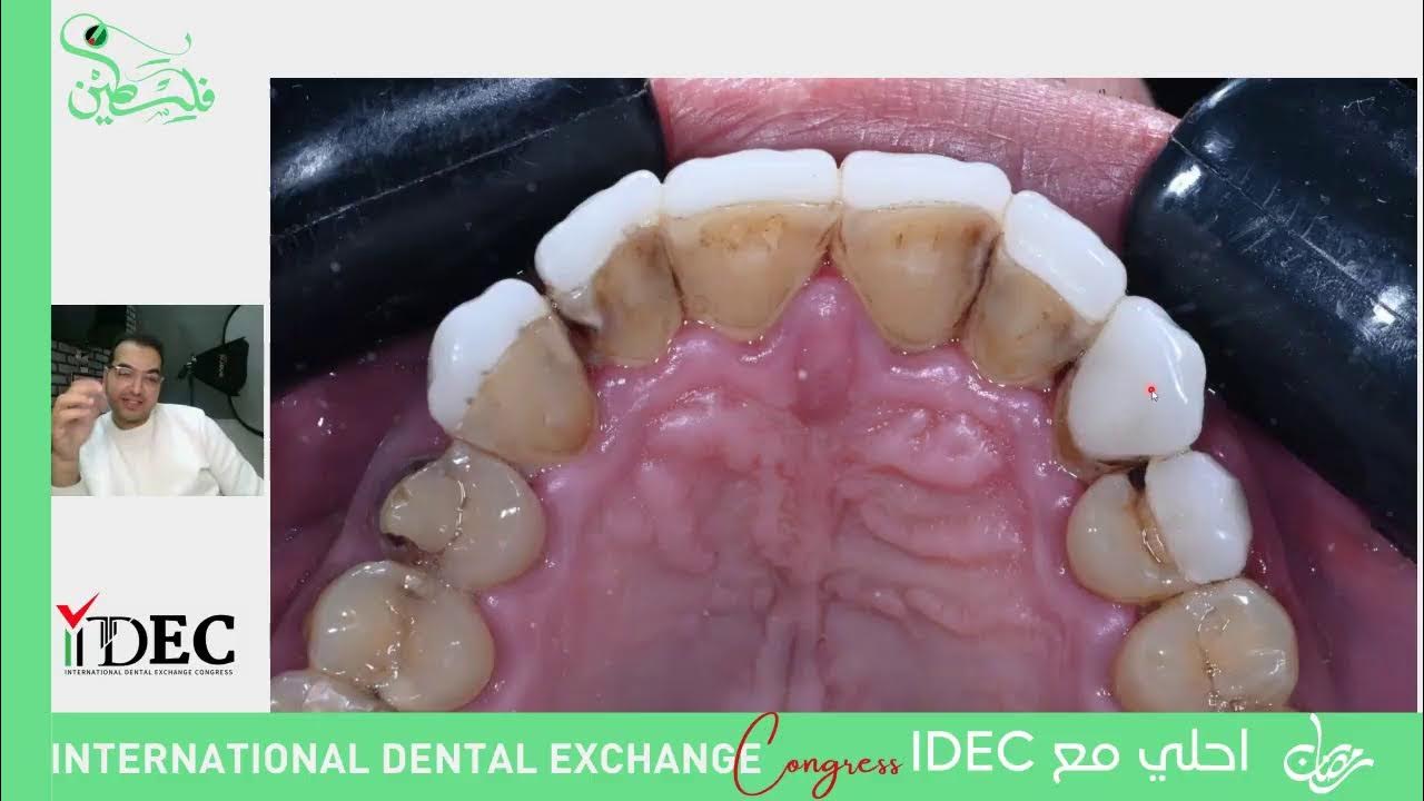 مع النجم المصري الدكتور عبدالله فاروق وضيف الIDEC لهذه الحلقة (Veneers