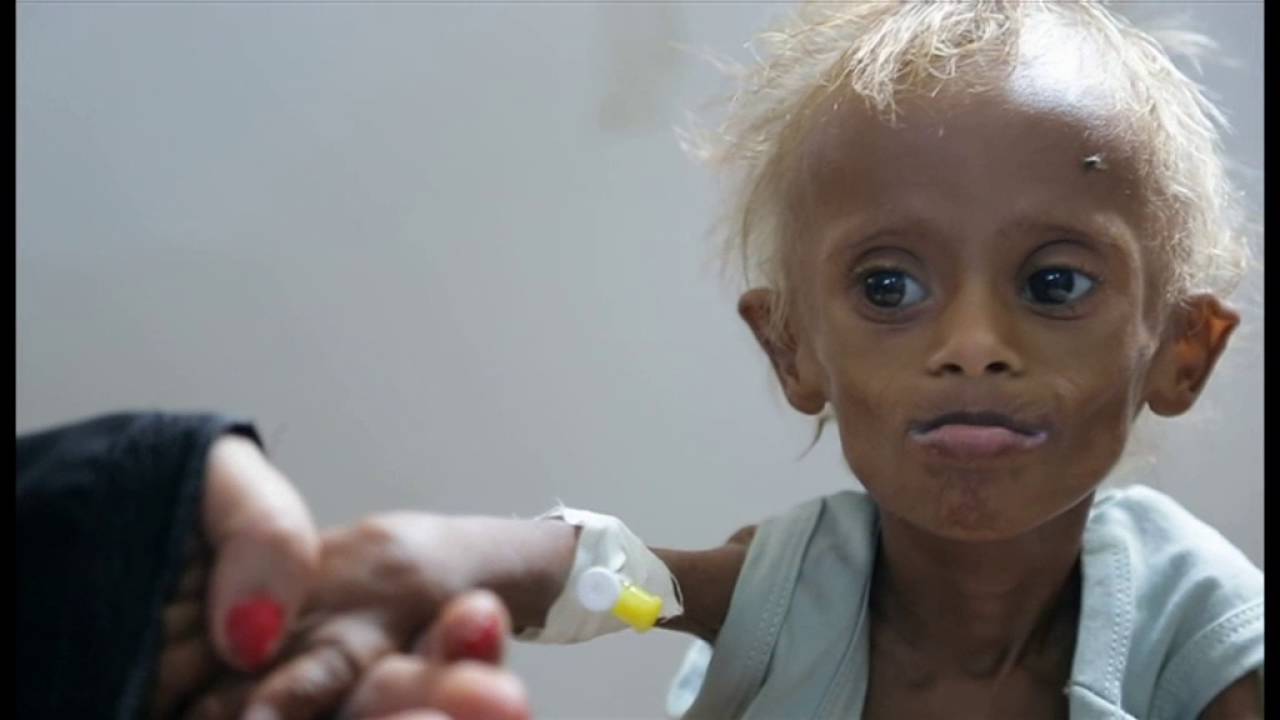Trẻ em Yemen chết đói do chiến tranh - YouTube