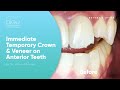 [Bleu Dentistry] Case Study: Immediate Temporary Crown & Veneer on Anterior Teeth