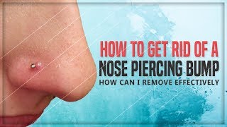 Nose Piercing Bump: 5 Simple Remedies to Get Rid of It at Home