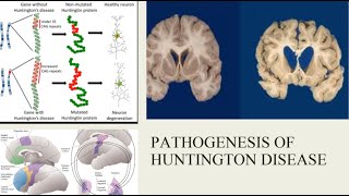 Huntington’s Disease: Our Current Understanding of Its Pathophysiology and Genetics screenshot 4