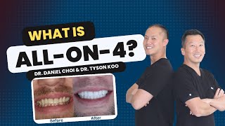 What is All on 4?:  Everything About All on 4 Dental Implants (Part 1)