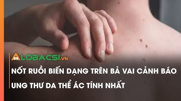 Nốt ruồi biến dạng trên bả vai cảnh báo ung thư da thể ác tính nhất