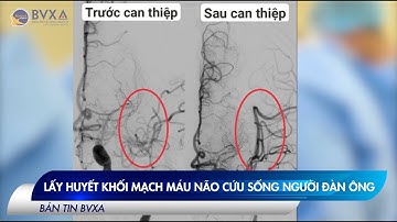 TIN NÓNG | LẤY HUYẾT KHỐI MẠCH MÁU NÃO CỨU SỐNG NGƯỜI ĐÀN ÔNG BỊ ĐỘT QUỴ.