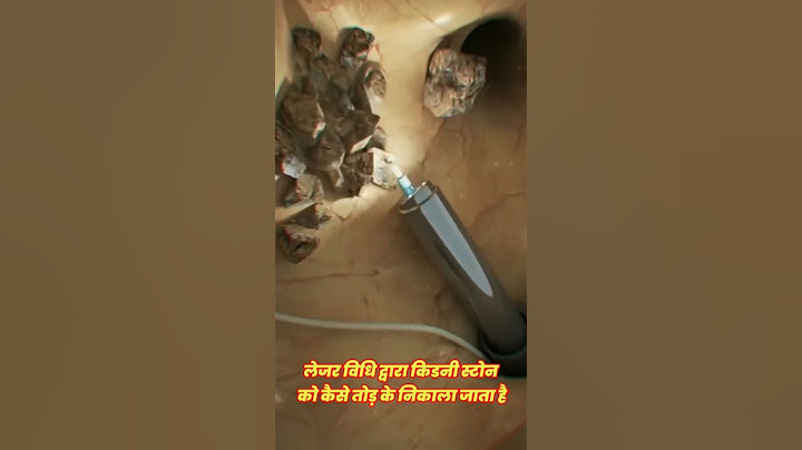 kidney stone removal by laser technique #short #kidney #neet #shorts #trendingshorts #medico #shots