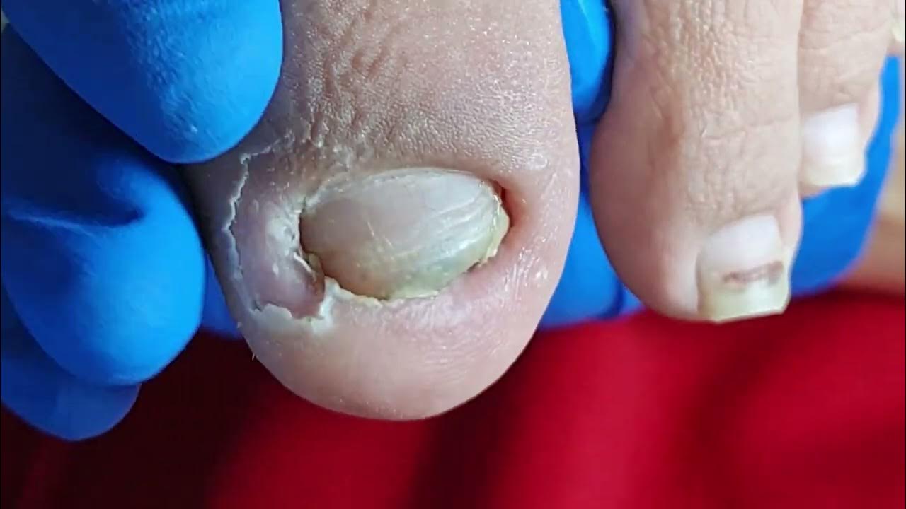 Trim toenails & Inset Toenail Care YouTube