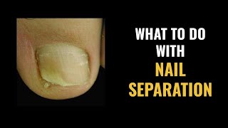 NAIL SEPARATION - What to DO and What are the CAUSES?